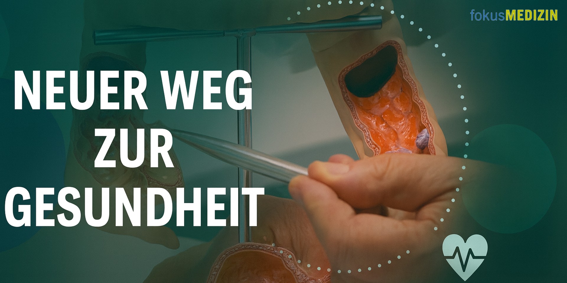 Darmkrebs – Endoprothetik